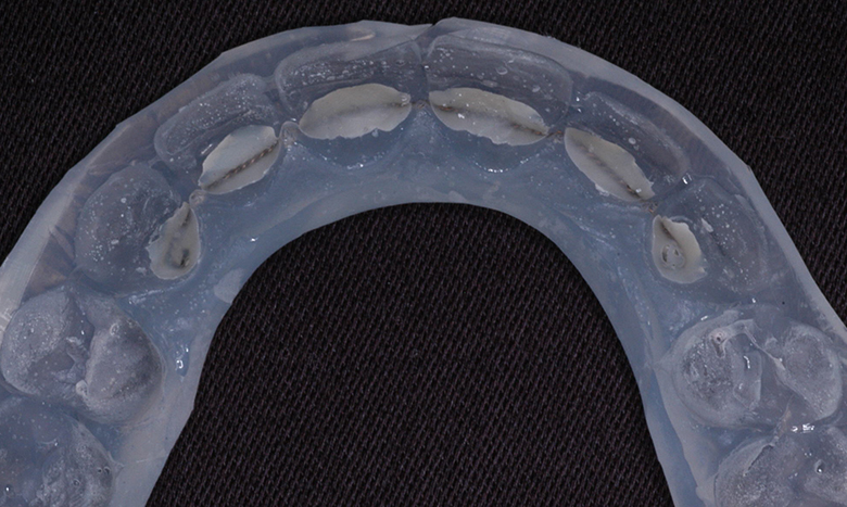 Retainer in Tray