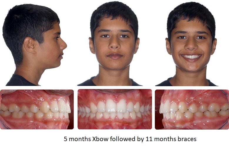 5 months Xbow followed by 11 months braces