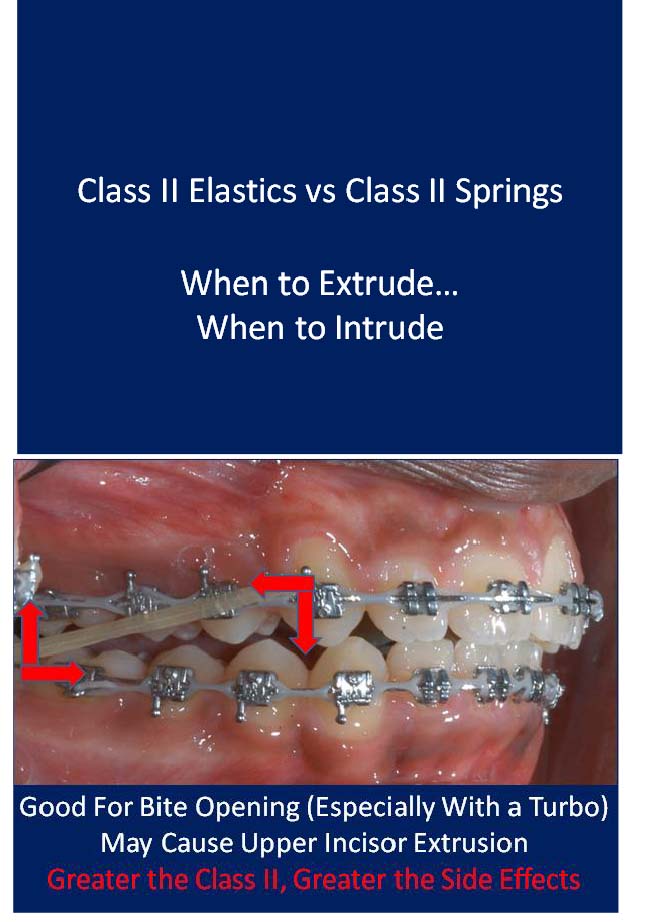 Class II Elastics vs Class II Springs 1