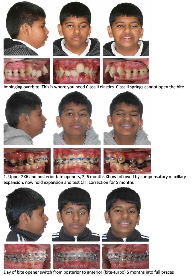 Class II Elastics vs Class II Springs 5